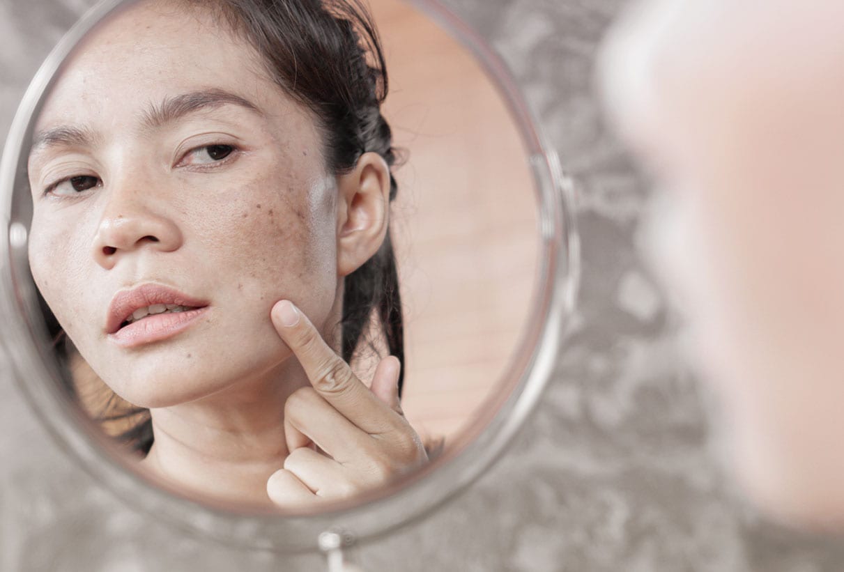 fungal acne on face harley street