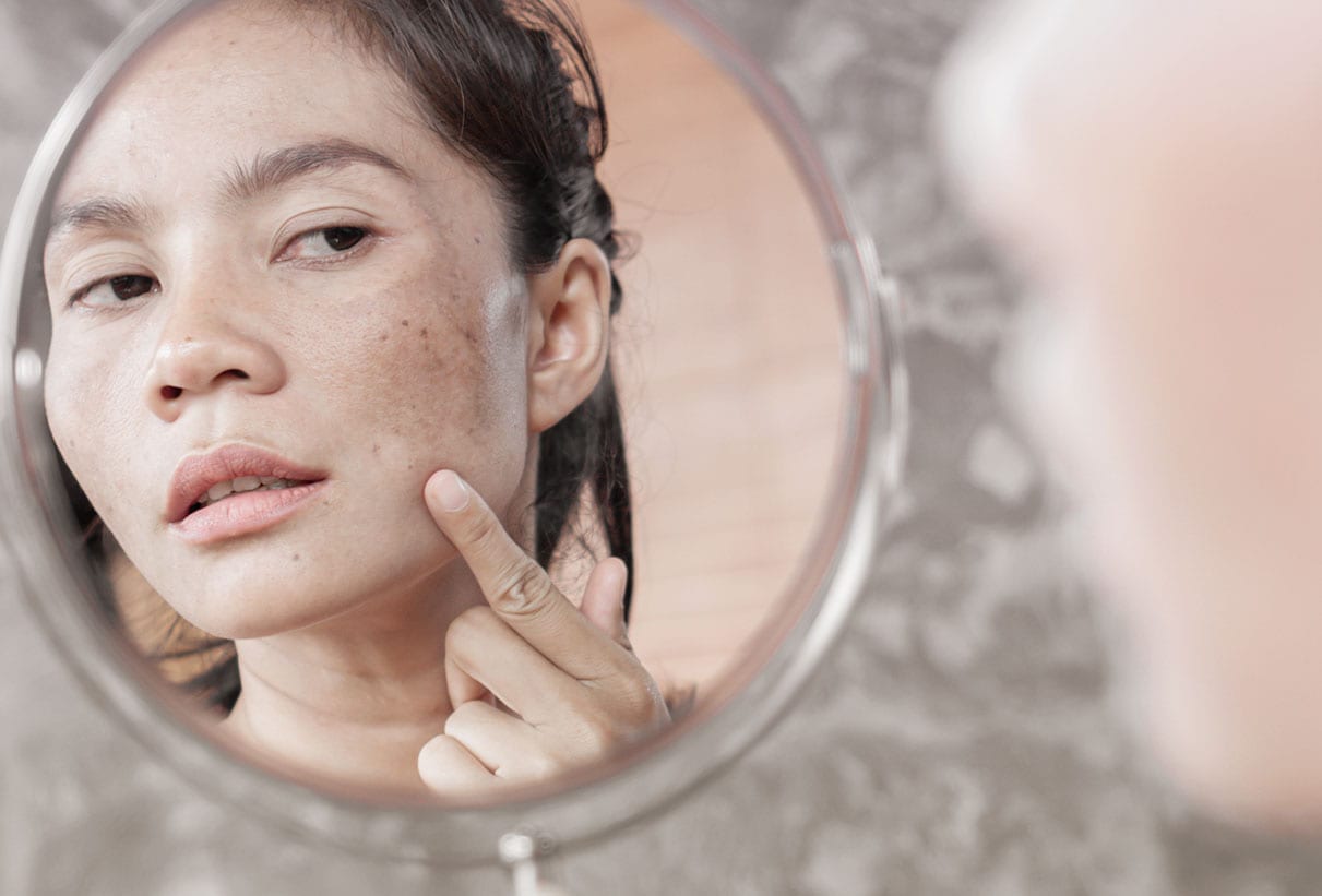 understanding acne harley street