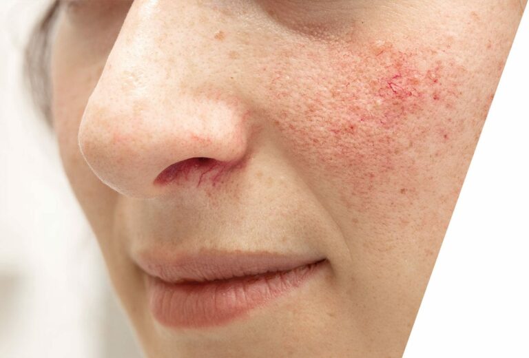 AM-med-derm-rosacea