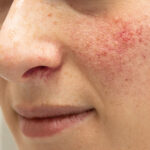 BBL therapy and Clear Silk treatment for rosacea