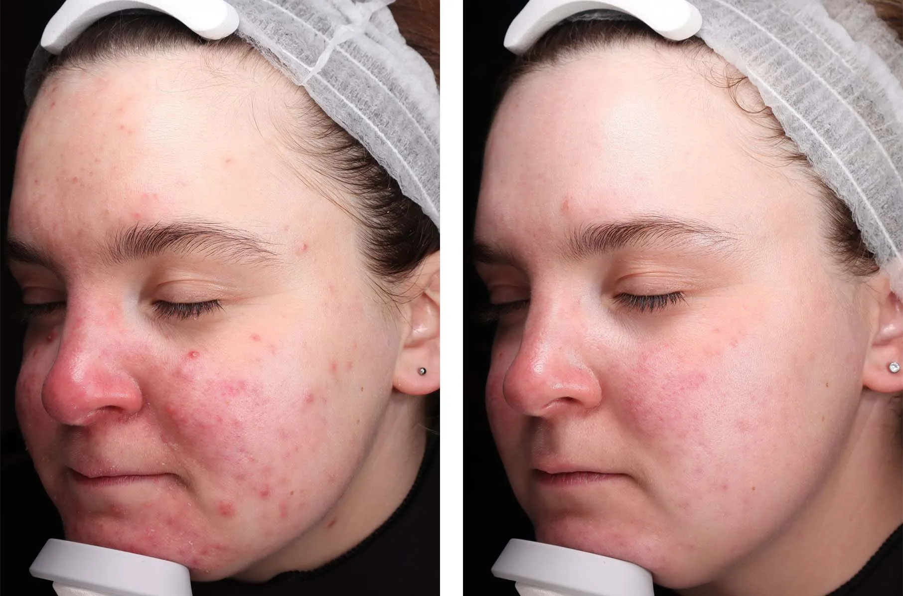 does semaglutide cause cystic acne Ozempic Face: What is it and how can you avoid it Will Cystic Acne Ever Go
