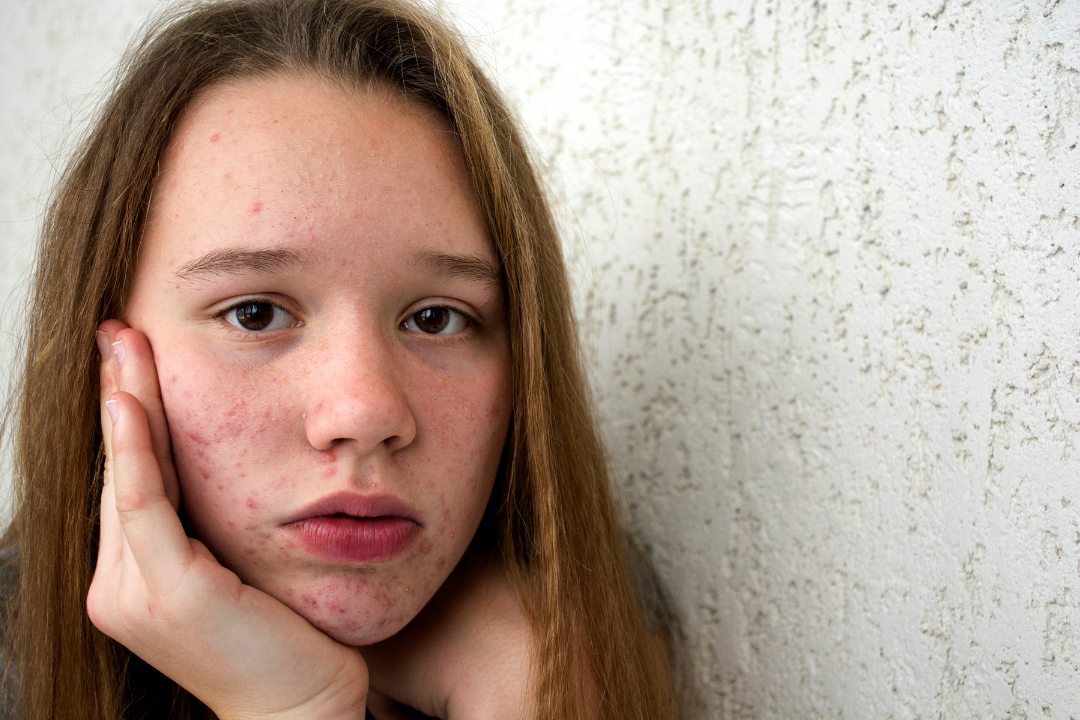 Best Acne Treatments for Teenagers | AviClear Laser at Self London