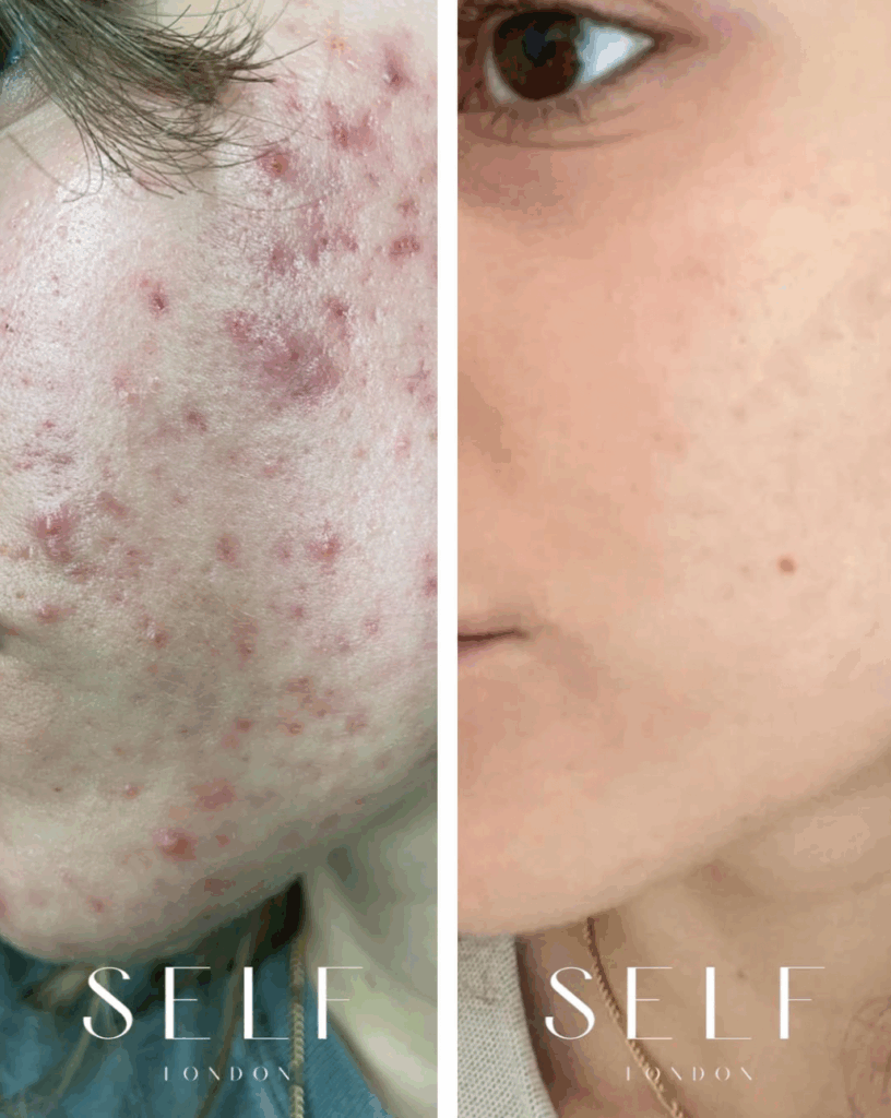 A Before & After Image of Acne Treatment with AviClear