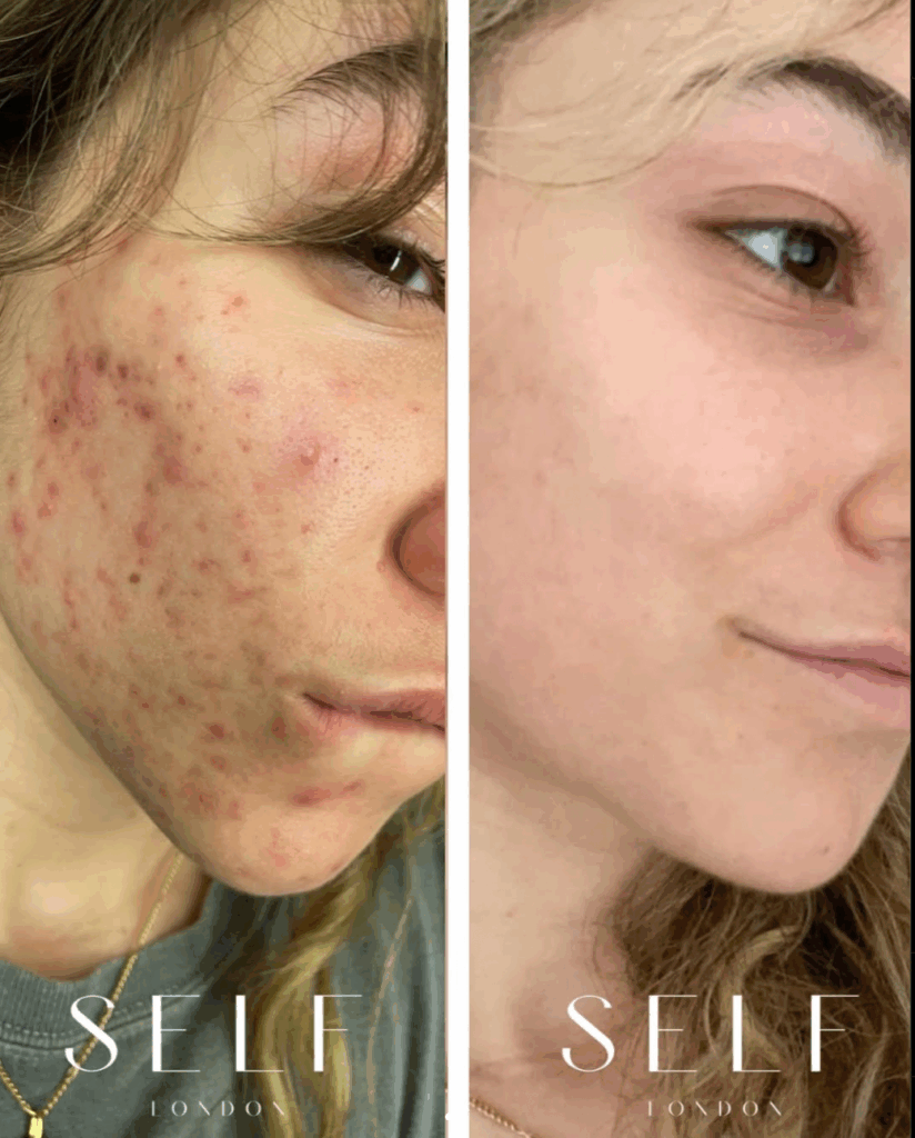 Before & After Image of Acne Treatment with AviClear