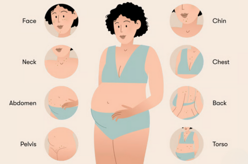 Pregnancy Acne
