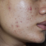 Why some acne scars don’t fade: The science behind permanent skin damage