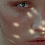 How to prevent rosacea flare-ups in winter