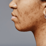 Tinted sunscreen for melasma and pigmentation: what the 2026 international consensus on visible light photoprotection actually recommends