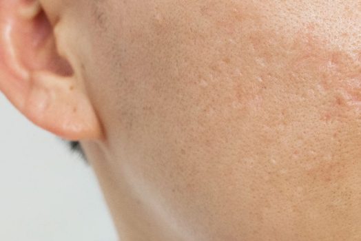 acne scar removal harley street