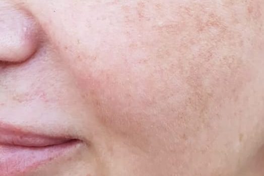 pigmentation treatment harley street