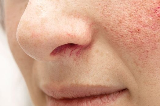 rosacea treatment harley street